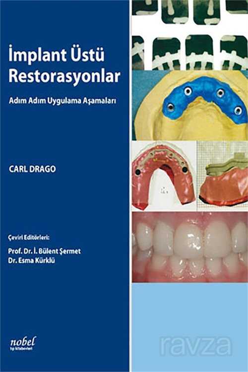 İmplant Üstü Restorasyonlar: Adım Adım Uygulama Aşamaları - 1