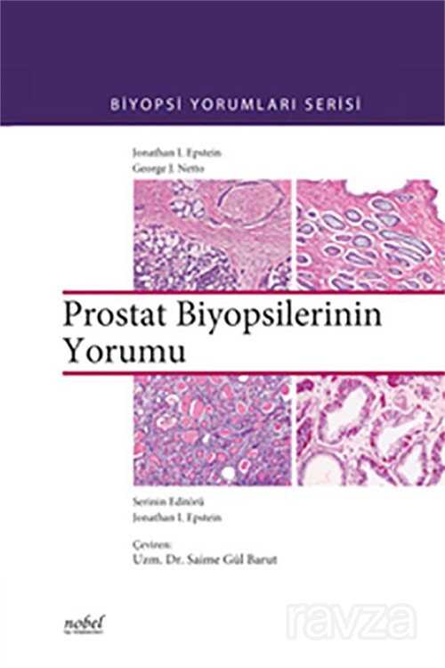 Prostat Biyopsilerinin Yorumu - Biyopsi Yorumları Serisi - 1