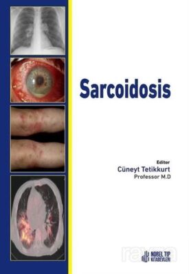 Sarcoidosis - 1
