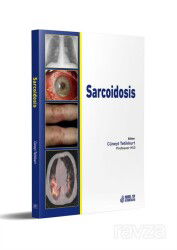 Sarcoidosis - 2
